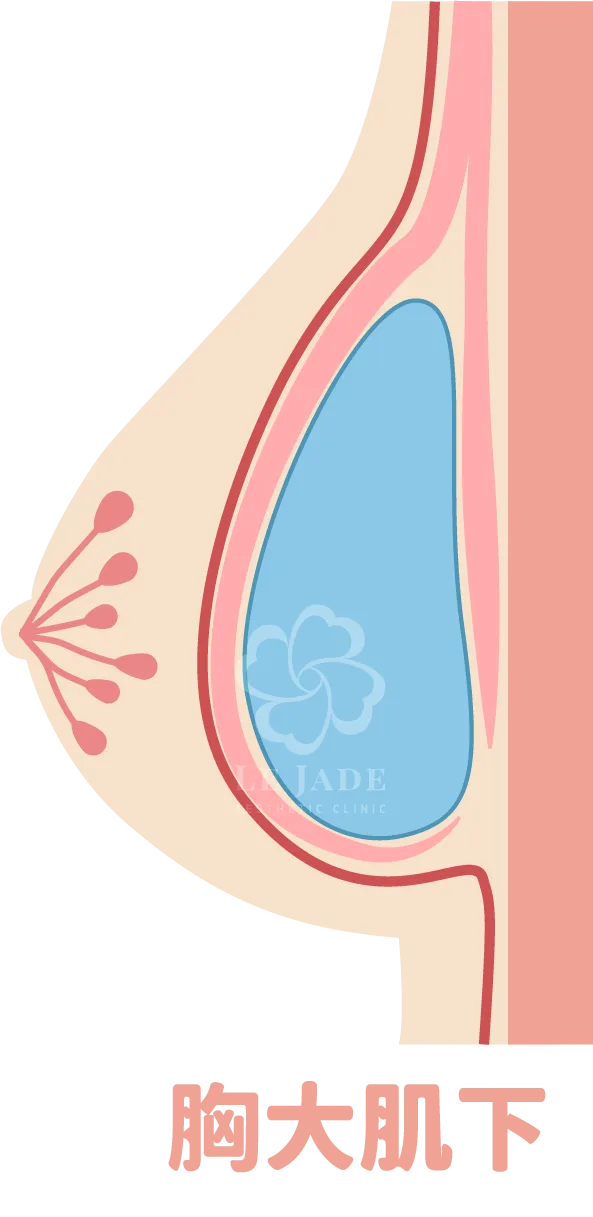 隆乳手術,隆乳放置位置,隆乳材質