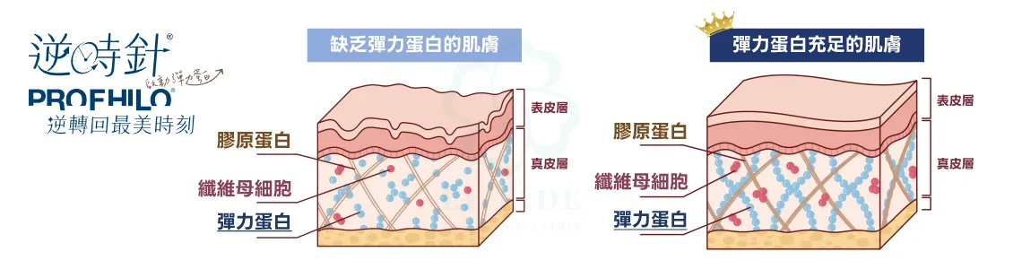 profhilo逆時針,玻尿酸,微整形,老化,醫美