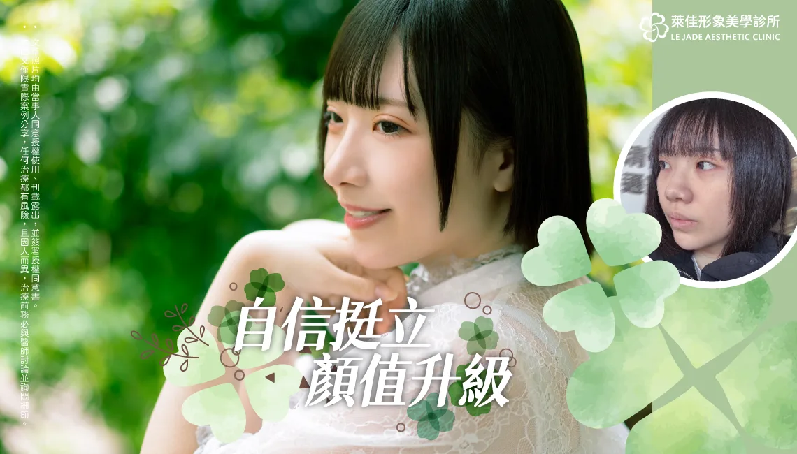 【自體肋骨隆鼻+縮鼻翼+敲鼻骨】改善大塌鼻，自信挺立、顏直升級隆鼻案例分享