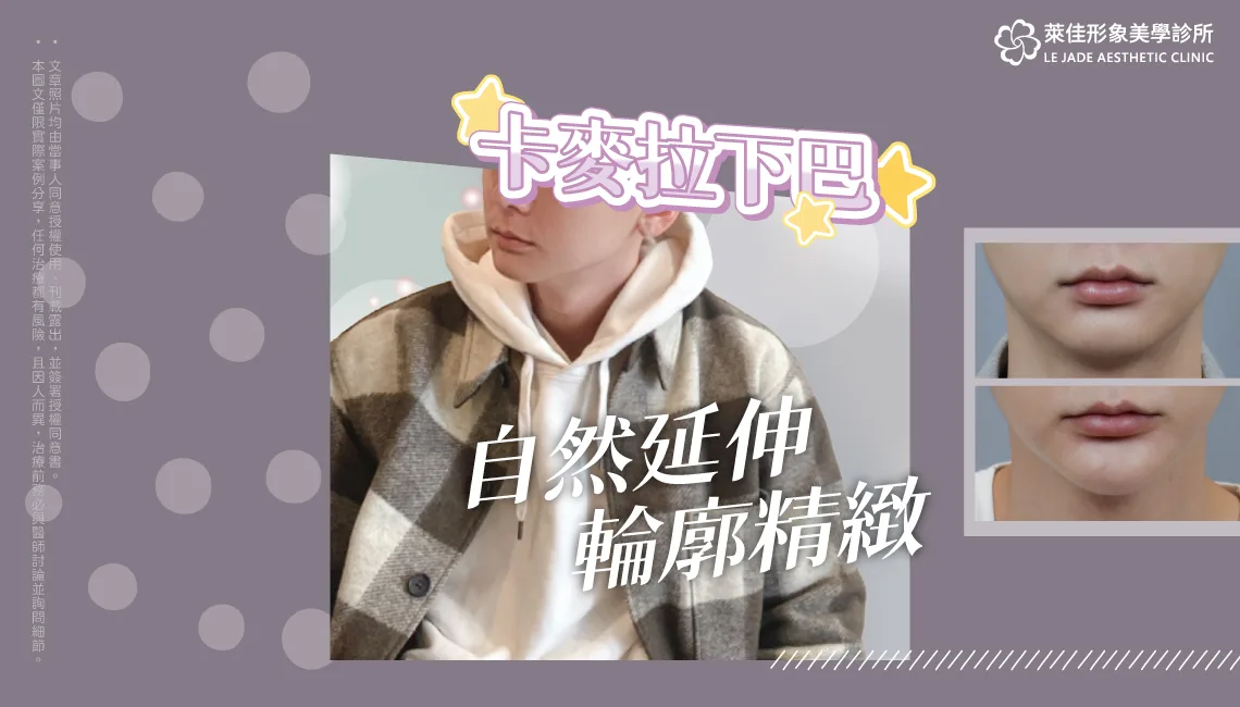 【卡麥拉下巴】矯正牙齒後下巴變短，自然延伸下巴墊下巴案例分享