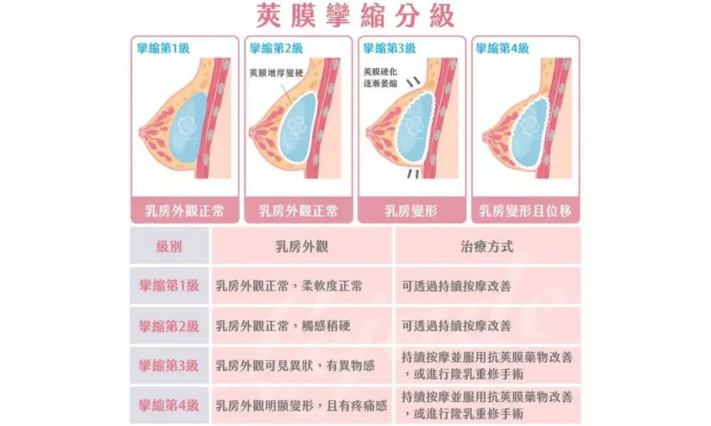 隆乳莢膜攣縮怎麼辦？症狀及感覺是什麼？莢膜攣縮常見問題Q&A