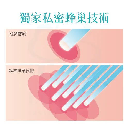 菲蜜莉,菲蜜莉雷射,菲蜜莉雷射蝴蝶電波,菲蜜莉雷射蒙娜麗莎,菲蜜莉雷射美白,私密雷射