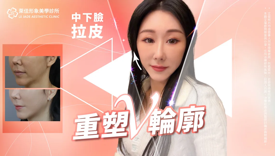 【中下臉拉皮】重塑V輪廓，拉皮案例分享
