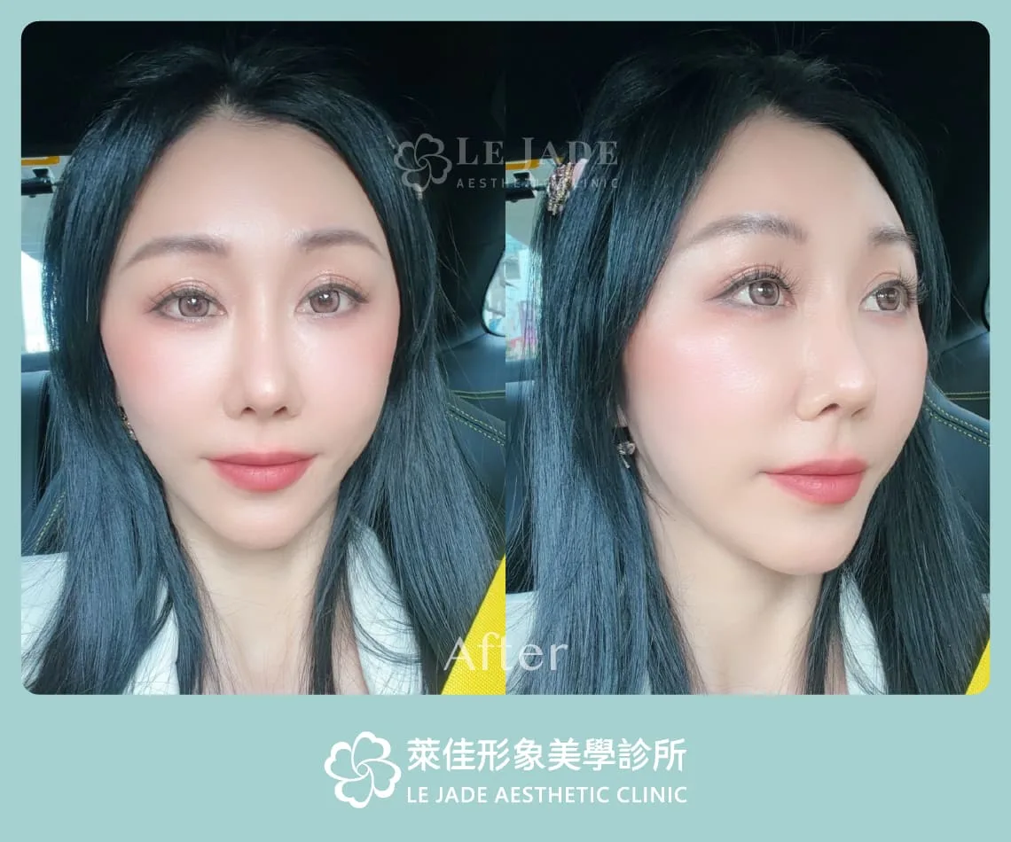 中下臉拉皮術後生活紀錄照