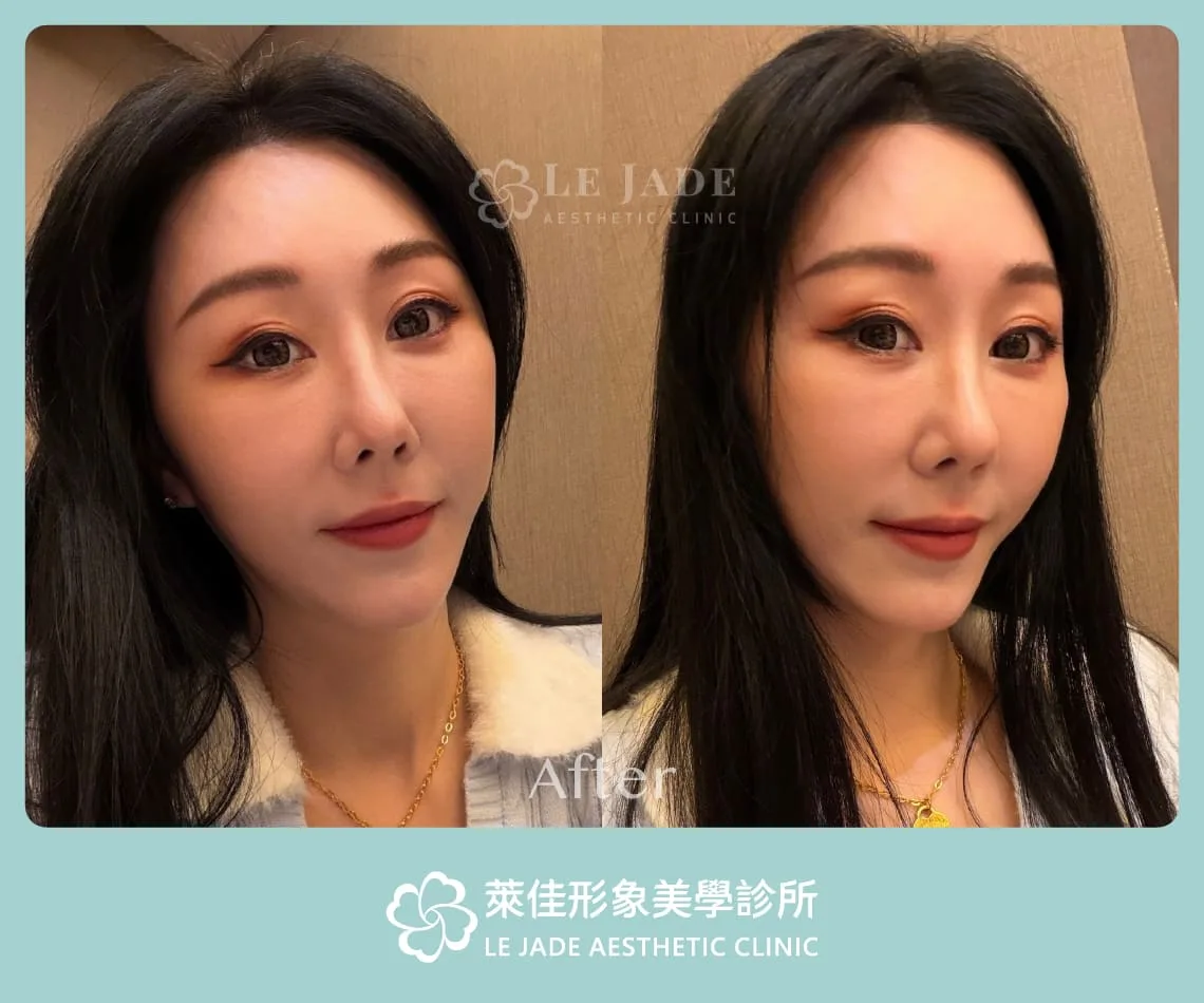 中下臉拉皮術後生活紀錄照