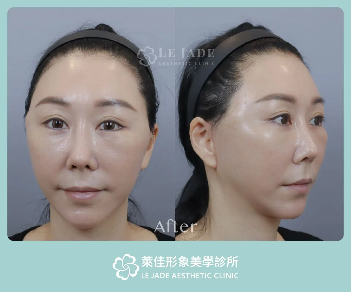 中下臉拉皮術後1個月