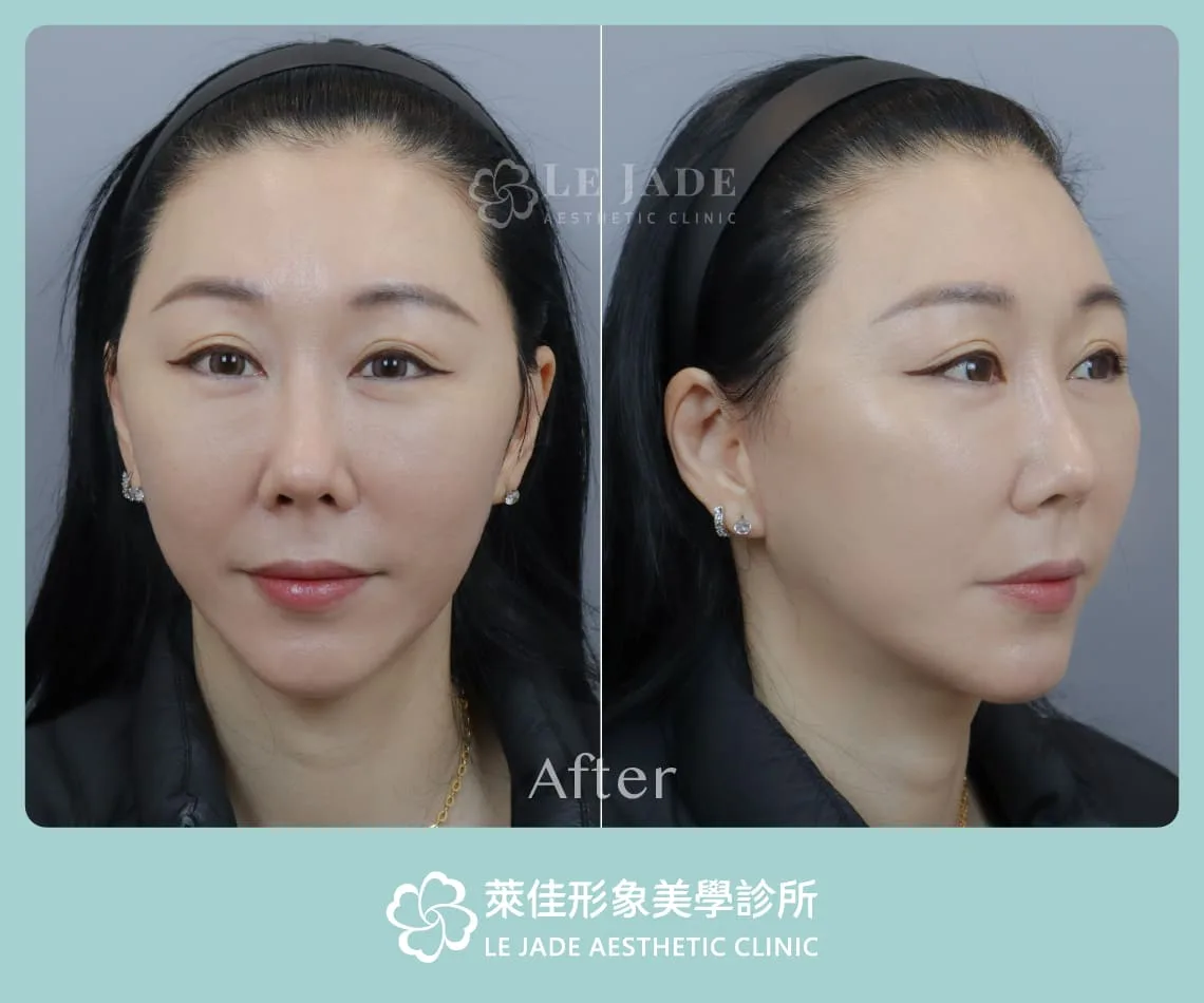 中下臉拉皮術後3個月紀錄照