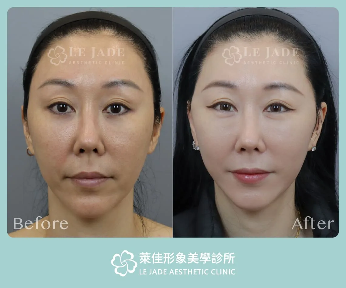 中下臉拉皮術前術後正面照