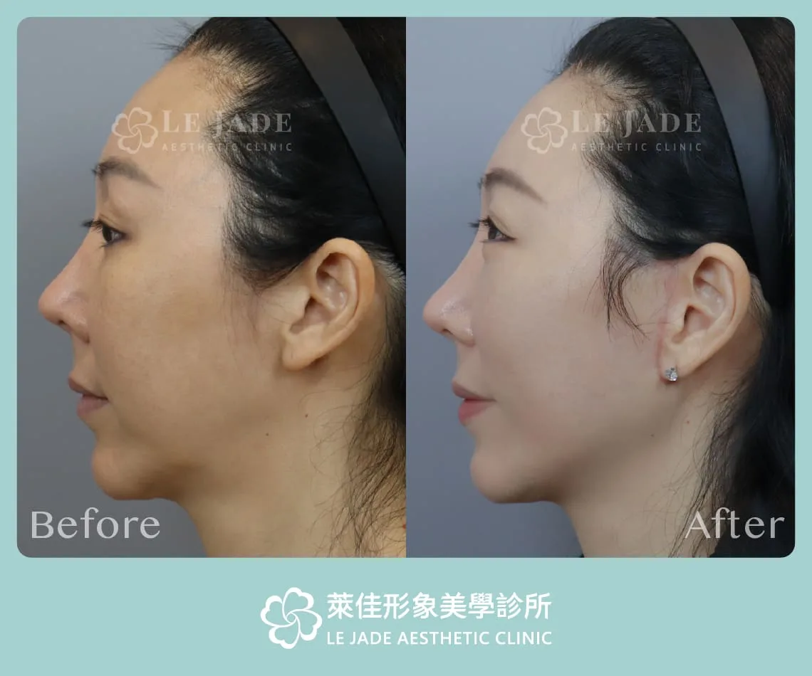 中下臉拉皮術前術後照