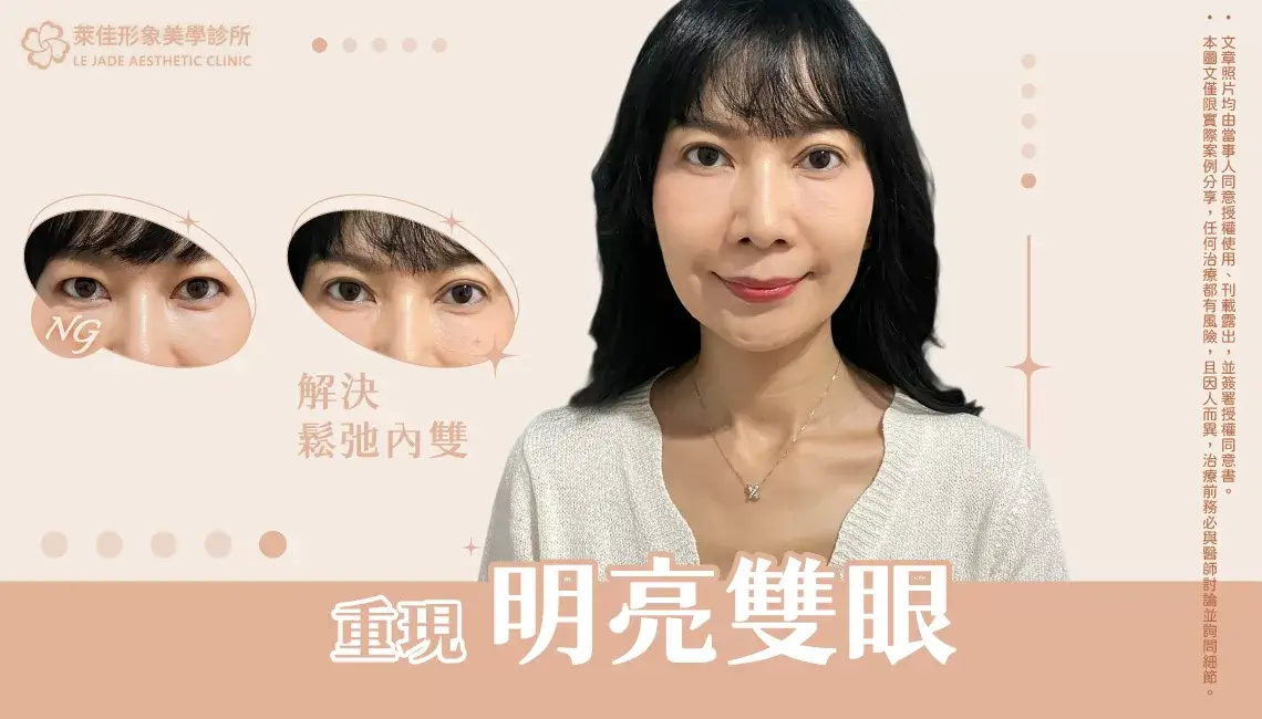 【雙眼皮手術】眼皮下垂變內雙,老化性雙眼皮鬆弛改善案例分享