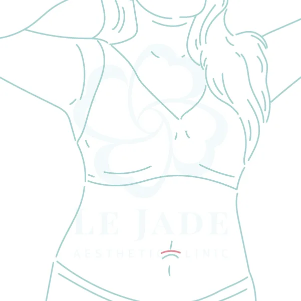 隆乳手術,隆乳材質,隆乳切口,隆乳懶人包