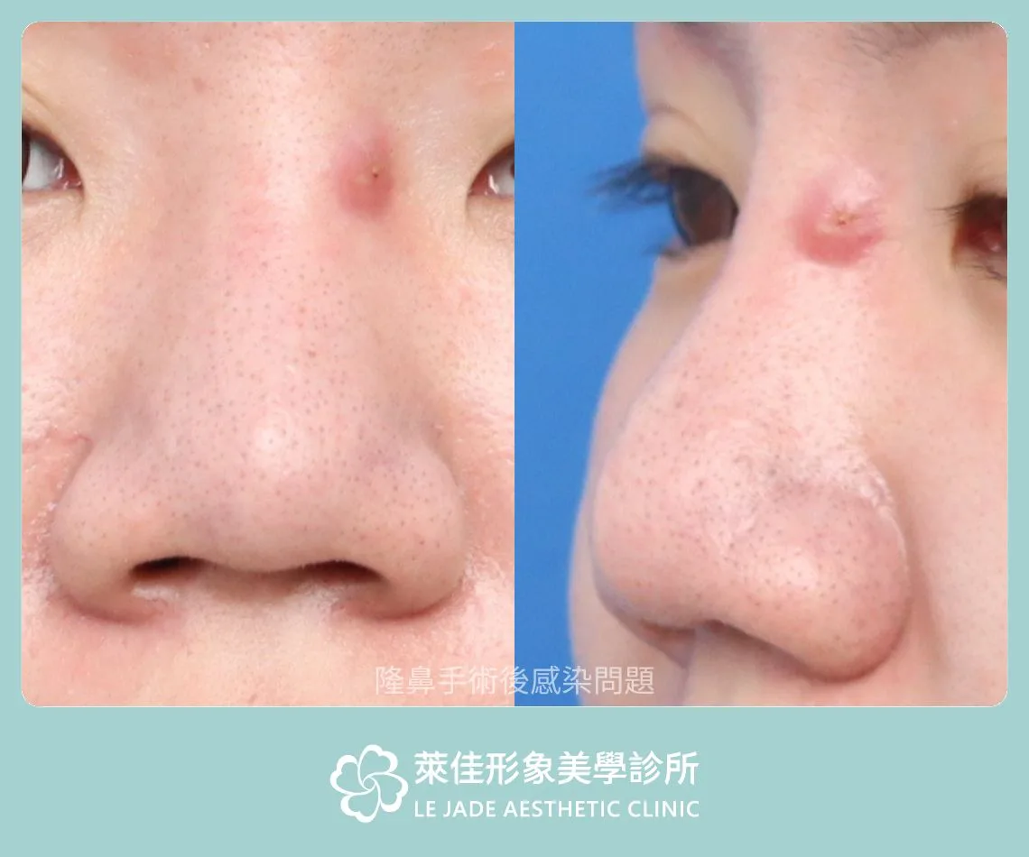 隆鼻失敗案例，感染問題