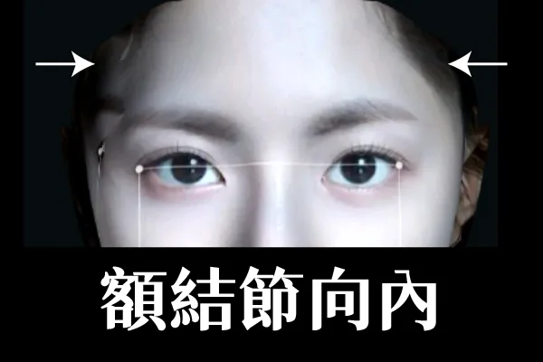 3D列印,完形美,豐額,太陽穴填補,凹臉