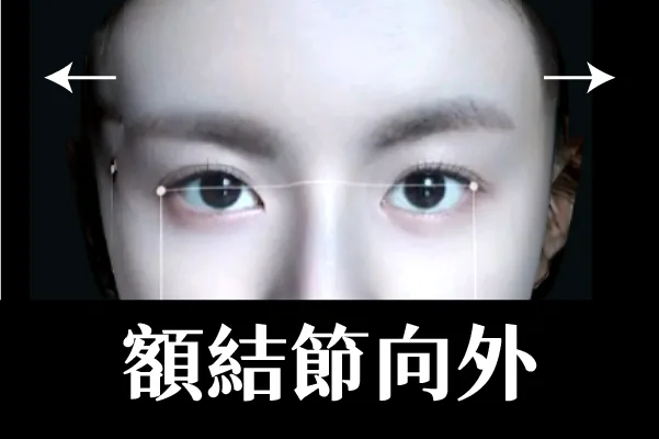 3D列印,完形美,豐額,太陽穴填補,凹臉