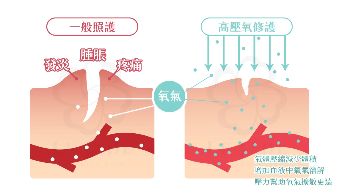 高壓氧治療能夠提高血液含氧量