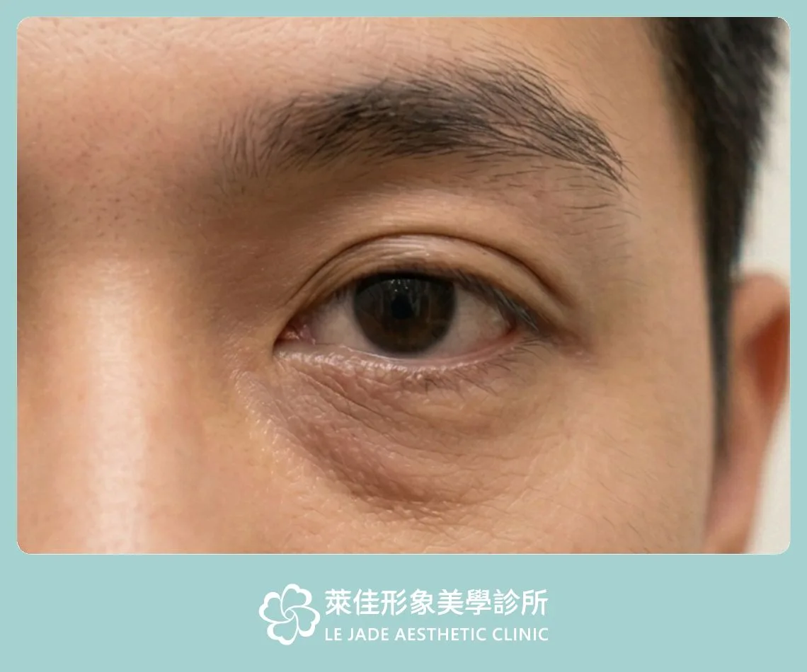 鬆弛型眼袋示意圖