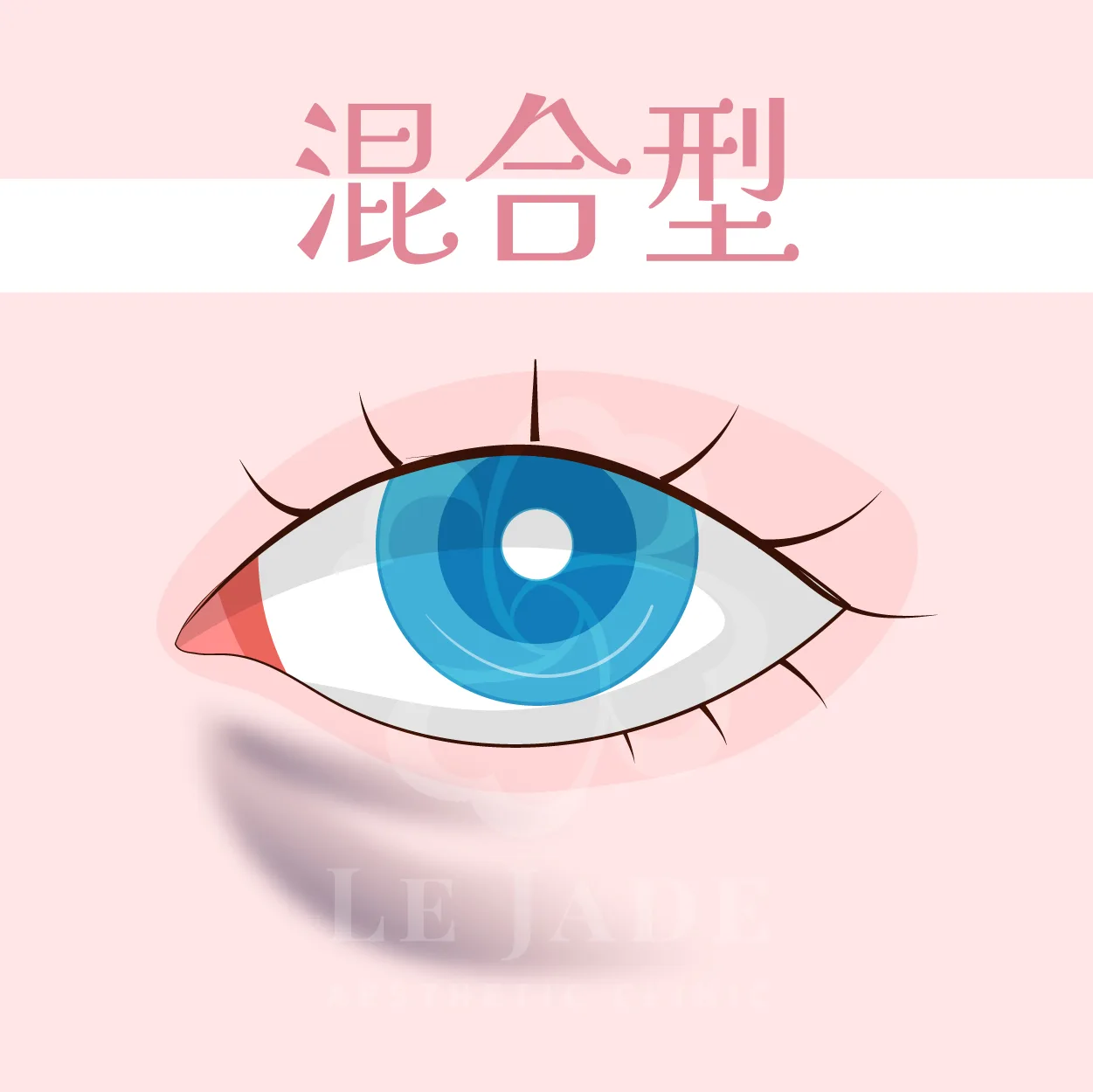 黑眼圈,黑眼圈治療,黑眼圈醫美,黑眼圈治療,黑眼圈消除