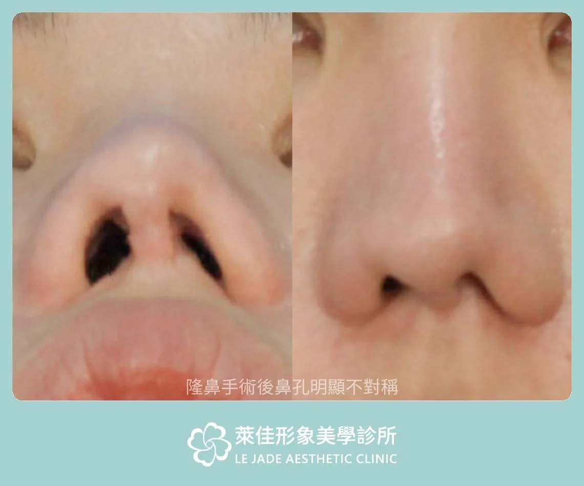 隆鼻失敗案例，鼻孔明顯不對稱