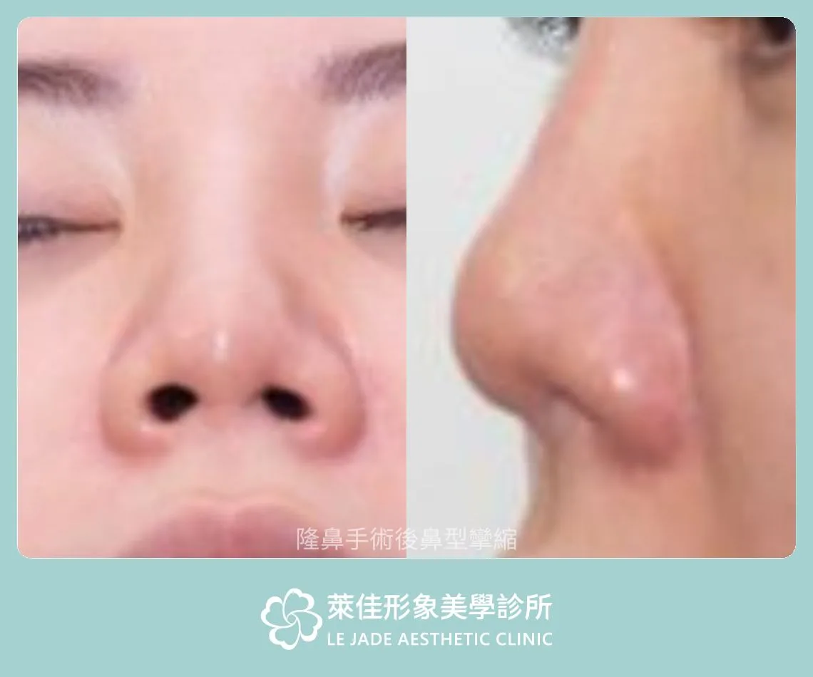 隆鼻失敗案例，鼻頭攣縮變朝天鼻